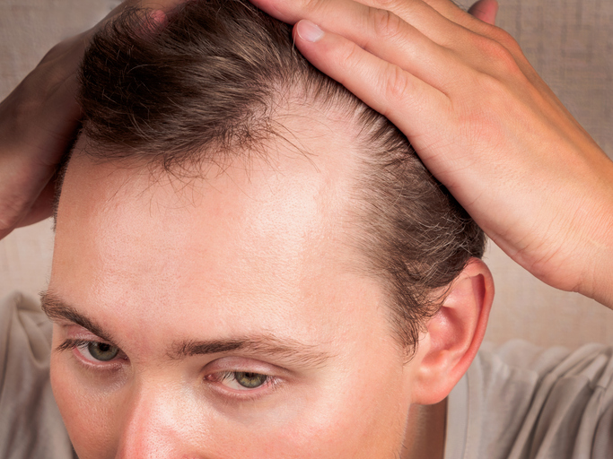 Androgenetische Alopezie