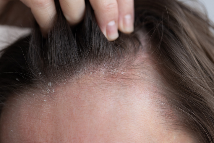 Seb. Dermatitis